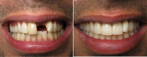 Dental Bridges Before and After Pictures in Kinston, NC