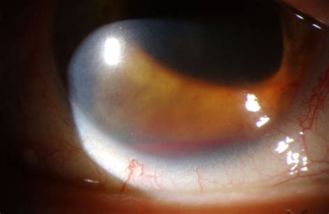 Hyphema causes, symptoms, grading, complications, recovery & treatment