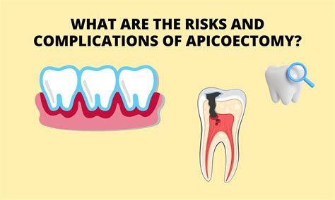 Apicoectomy Pain After 6 Months (Why’s My Tooth Still Aching?(Quick Guide)