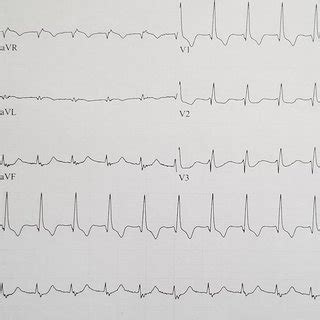 Accelerated junctional rhythm with retrograde conduction, incomplete ...