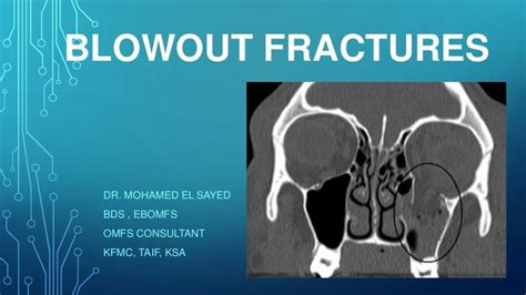 Blowout fractures