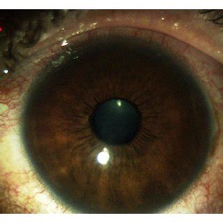 Gonioscopy of the right eye shows wide open and much pigmented chamber... | Download Scientific ...