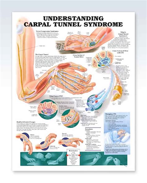 Carpal Tunnel Syndrome Exam-Room Anatomy Poster – ClinicalPosters