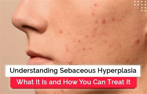 Understanding Sebaceous Hyperplasia: What It Is and How You Can Treat It | Winston Salem Dermatology