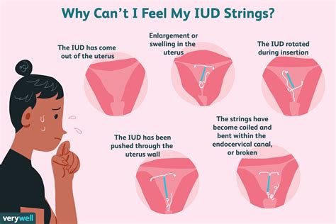 Can An Iud Stop Your Period