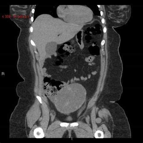 CT Scan of the Abdomen - Los Angeles, CA | Cedars-Sinai