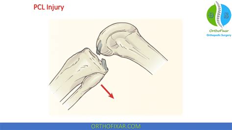 Posterior Drawer Test Of The Knee | OrthoFixar 2025