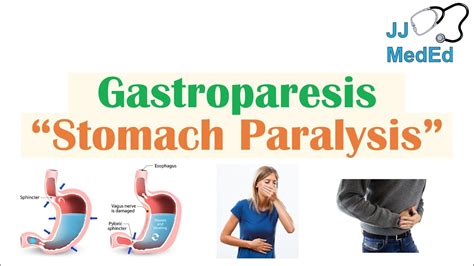 Gastroparesis (Stomach Paralysis) | Causes and Risk Factors, Signs & Symptoms, Diagnosis ...