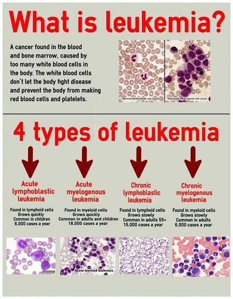 funnydoc: “4 types of leukemia!! ” | Medical laboratory science, Oncology nursing, Medical ...