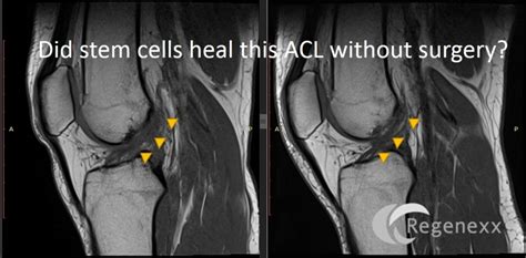 ACL surgery cost