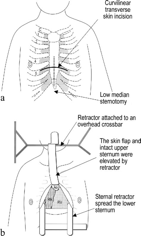 Figure 1 from A minimal transverse incision with low median sternotomy ...