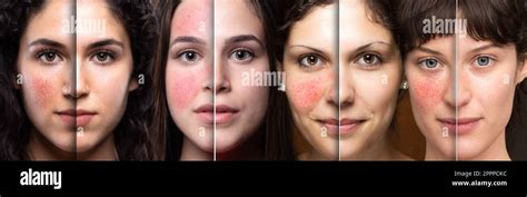 Collage of women's faces showing before and after laser treatment for ...