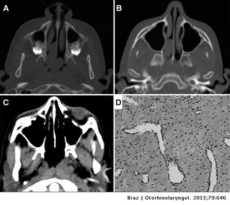 Extranasopharyngeal angiofibroma of the nasal septum - uncommon presentation of a rare disease ...