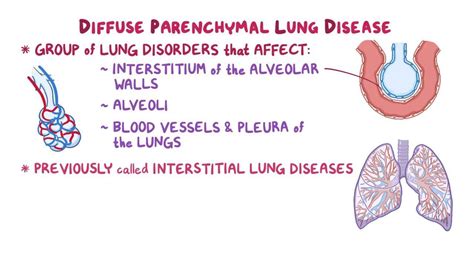 Diffuse parenchymal lung disease: Clinical practice - Osmosis