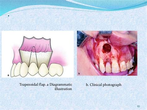 surgical flaps oral surgery