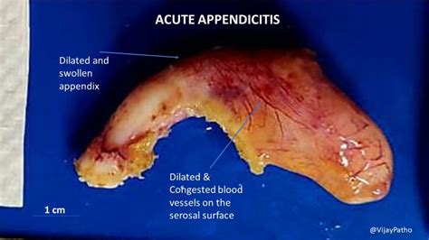 Appendix Inflammation