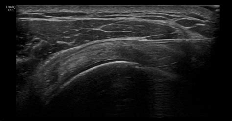 Subacromial subdeltoid bursa injection – transverse approach