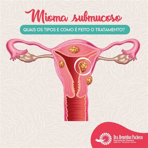 Mioma submucoso | Dra. Remédios Pacheco - Reprodução Humana | (85) 3031-3592 | 99833-2303