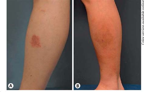 Treatment of Pigmented Purpuric Dermatosis with Topical Photodynamic Therapy | Semantic Scholar