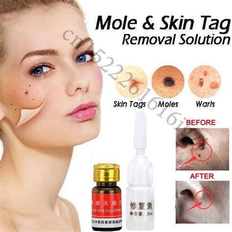 Mole & Skin Tag Removal Solution Painless Mole Skin Dark Spot Removal Face Wart Tag Freckle ...