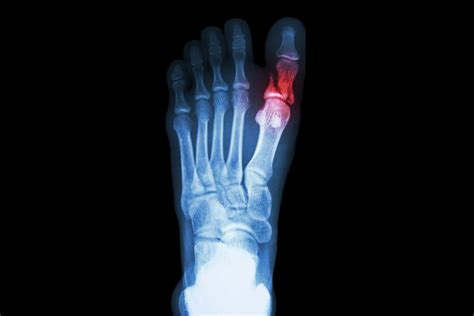 Broken Pinky Toe Signs & Symptoms | Canyon Oaks Foot & Ankle