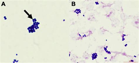 Aerococcus urinae: an emerging, gram-positive pathogen causing urinary tract infection - The ...