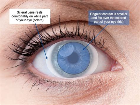 Scleral Contact Lenses | Focal Pointe Eye Care