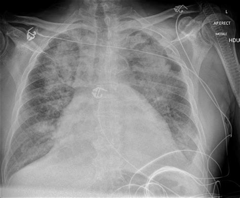 Flash Pulmonary Edema Chest X Ray