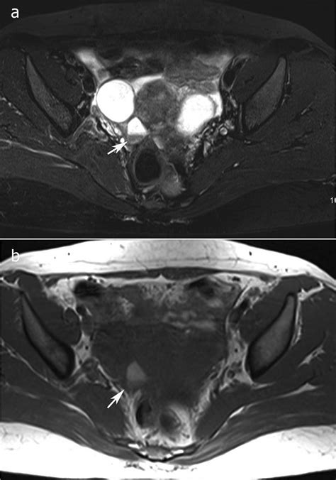 Radiodiagnosis - Imaging is Amazing-Interesting cases: Endometrioma - MRI