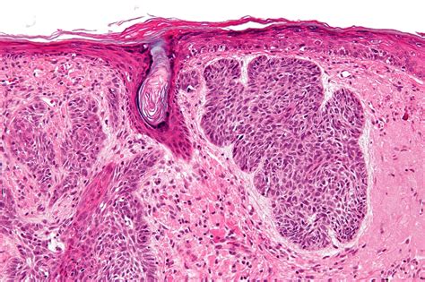 Basal Cell Carcinoma, Skin, Nuclear, Wikipedia, High