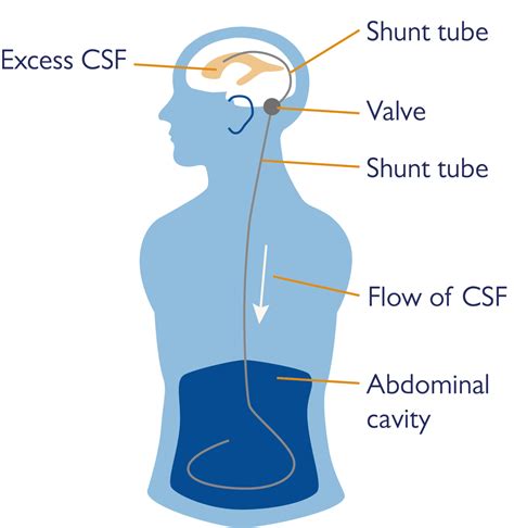 What Is A Magnetic Shunt at John Shavers blog