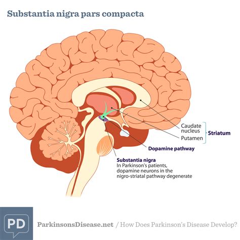 What Are The Causes of Parkinson's Disease?