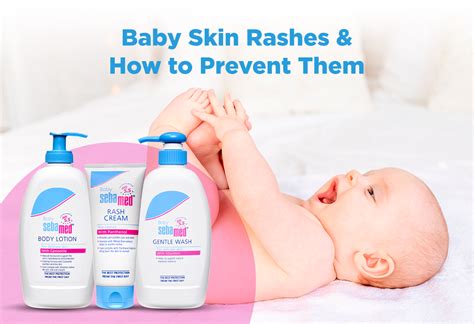 Baby’s Skin Rash – Causes, Treatment & Prevention Tips - FirstCry Parenting