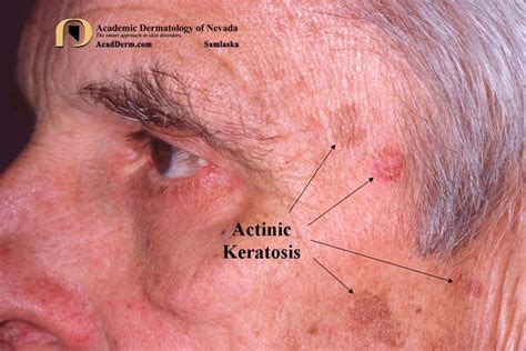 Actinic Keratosis: What is it? - Academic Dermatology of Nevada