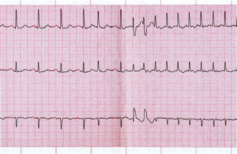 Abnormal Ecg Chart