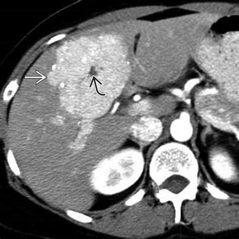 Clínica Factum - Cirurgia do Aparelho Digestivo Nódulos hepáticos