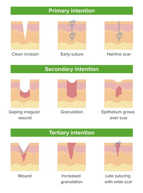 Wound Healing | Concise Medical Knowledge