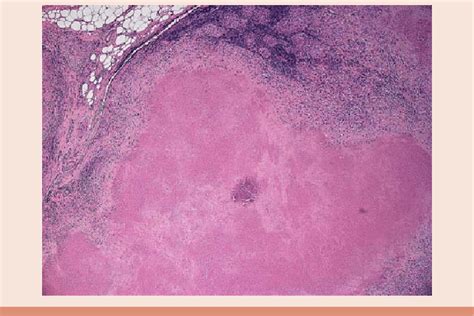 Panoramic view of lymph node with extensive caseous necrosis and ...