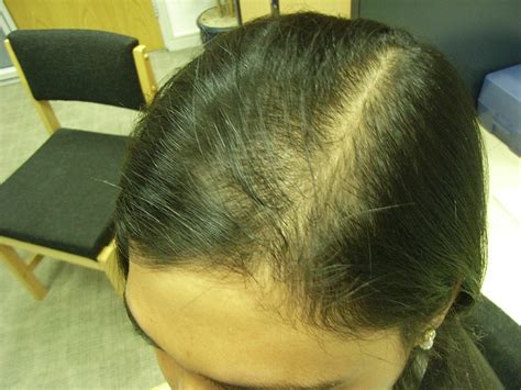 The Hair Centre | Female Hair Loss (Asian) Stabilisation And Early Strengthening Of Hair In The ...