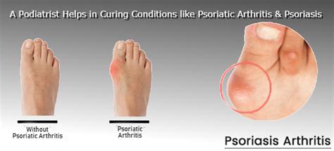 Psoriatic Arthritis Toes