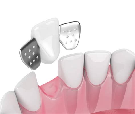 Resin-Bonded Bridge | DrJCares - Resin-Bonded Bridge