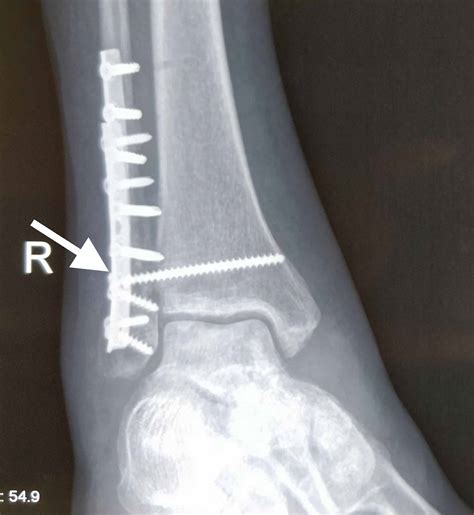 Cureus | Osteoporotic Distal Fibula Fractures in the Elderly: How To Fix Them