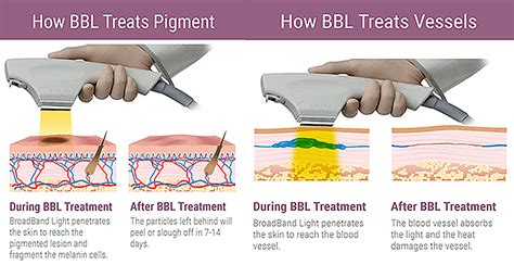 BBL vs. IPL • LA Longevity