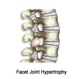 What Is Facet Joint Hypertrophy - mapasgmaes