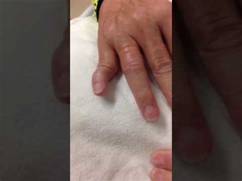 Dislocated pinky finger - YouTube