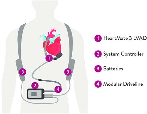 Heartmate III Schematic. | Download Scientific Diagram