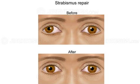 Exotropia before & after - #SUM0013 - Stock eye images