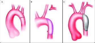 Anomalie congénitale coarctation de la chirurgie de l'aorte en Inde