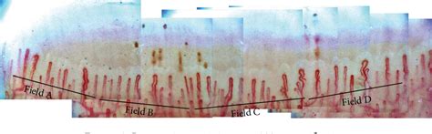 Nailfold Capillaroscopy | Semantic Scholar