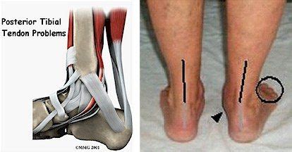 Posterior tibial tendonitis! | Feet! | Pinterest | Physical therapy